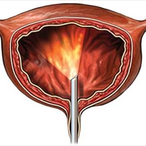 Mild Uti - Prevalence Of Urinary Tract Infection In Females - Why They Are More Prone To UTI